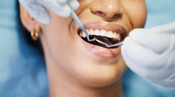 Best Knocked-Out Tooth (Avulsed Tooth) Treatment in East Peoria, IL